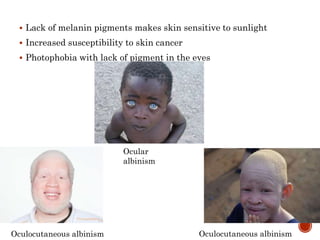  Lack of melanin pigments makes skin sensitive to sunlight
 Increased susceptibility to skin cancer
 Photophobia with lack of pigment in the eyes
Ocular
albinism
Oculocutaneous albinism Oculocutaneous albinism
 