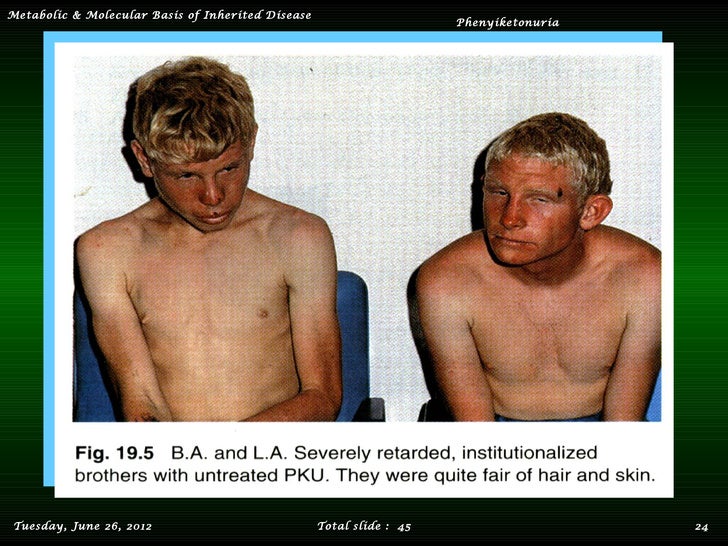 Phenylketonuria
Phenylketonuria Disease