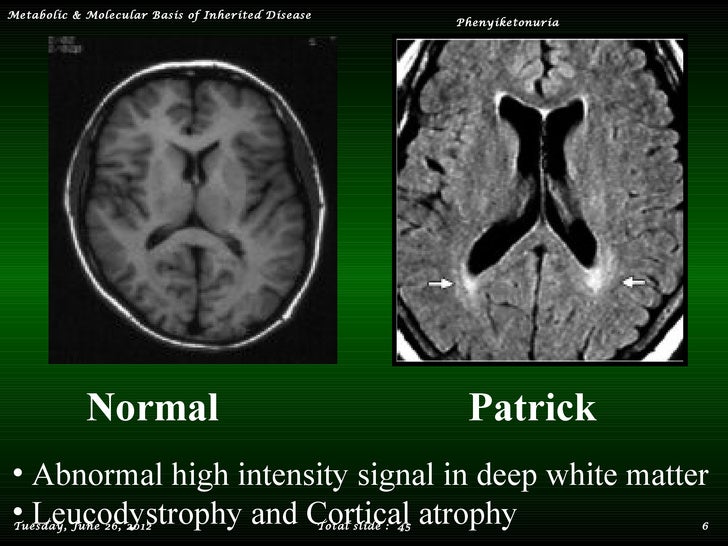 Phenylketonuria
Phenylketonuria Disease