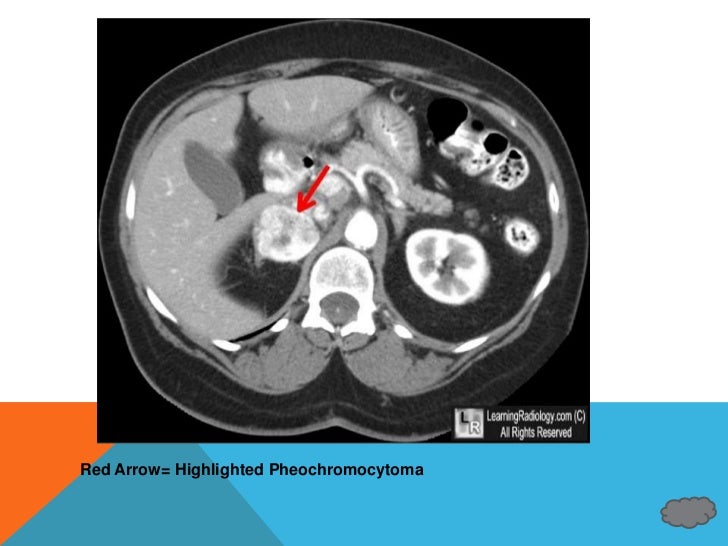 Pheochromocytoma