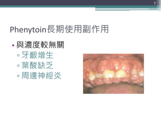 Phenytoin長期使用副作用
• 與濃度較無關
▫ 牙齦增生
▫ 葉酸缺乏
▫ 周邊神經炎
7
 