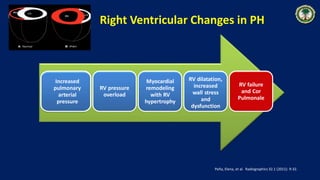 Right Ventricular Changes in PH
Increased
pulmonary
arterial
pressure
RV pressure
overload
Myocardial
remodeling
with RV
hypertrophy
RV dilatation,
increased
wall stress
and
dysfunction
RV failure
and Cor
Pulmonale
Peña, Elena, et al. Radiographics 32.1 (2011): 9‐32.
 