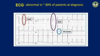 ECG- abnormal in ~ 80% of patients at diagnosis
.
 