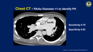 Chest CT - PA/Ao Diameter >1 to identify PH
Ao/PA
Ng CS et al. J Thorac Imaging.1999 Oct;14(4):270-8.
• Sensitivity 0.70
• Specificity 0.92
 