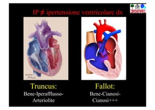 IP ≠ ipertensione ventricolare dx




  Truncus:                Fallot:
Bene-Iperafflusso-      Bene-Cianosi-
   Arteriolite           Cianosi+++
 
