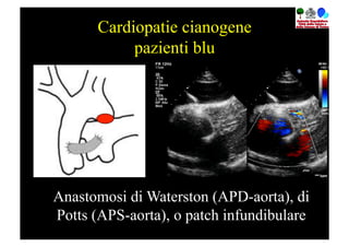 Cardiopatie cianogene
           pazienti blu




Anastomosi di Waterston (APD-aorta), di
Potts (APS-aorta), o patch infundibulare
 