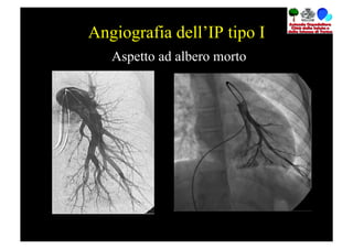Angiografia dell’IP tipo I
   Aspetto ad albero morto
 