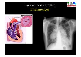 Pazienti non corretti :
    Eisenmenger
 