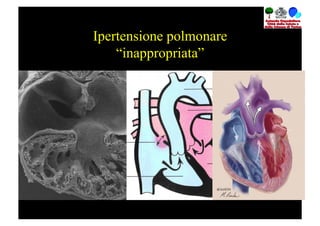 Ipertensione polmonare
    “inappropriata”
 