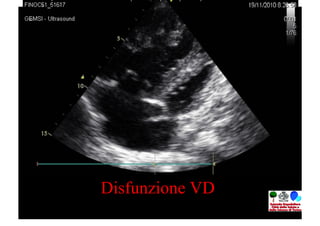 Disfunzione VD
 