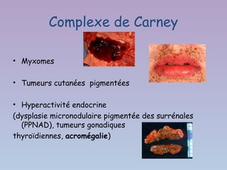 Complexe de Carney

• Myxomes

• Tumeurs cutanées pigmentées

• Hyperactivité endocrine
(dysplasie micronodulaire pigmentée des surrénales
  (PPNAD), tumeurs gonadiques
thyroïdiennes, acromégalie)
 
