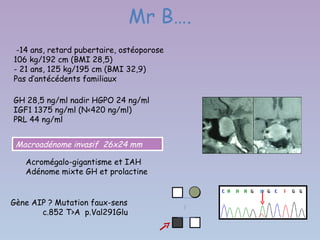 Mr B….
 -14 ans, retard pubertaire, ostéoporose
106 kg/192 cm (BMI 28,5)
- 21 ans, 125 kg/195 cm (BMI 32,9)
Pas d’antécédents familiaux

GH 28,5 ng/ml nadir HGPO 24 ng/ml
IGF1 1375 ng/ml (N<420 ng/ml)
PRL 44 ng/ml


 Macroadénome invasif 26x24 mm

   Acromégalo-gigantisme et IAH
   Adénome mixte GH et prolactine


Gène AIP ? Mutation faux-sens
       c.852 T>A p.Val291Glu
 