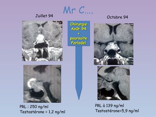 Juillet 94
                      Mr C….
                                            Octobre 94
                           Chirurgie
                           Chirurgie
                           Août 94
                            Août 94
                               +
                               +
                           poursuite
                           poursuite
                            Parlodel
                            Parlodel




PRL : 250 ng/ml                        PRL à 139 ng/ml
Testostérone = 1,2 ng/ml               Testostérone=5,9 ng/ml
 