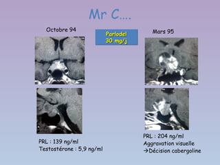Mr C….
  Octobre 94                             Mars 95
                           Parlodel
                           Parlodel
                           30 mg/j
                           30 mg/j




                                      PRL : 204 ng/ml
PRL : 139 ng/ml                       Aggravation visuelle
Testostérone : 5,9 ng/ml              Décision cabergoline
 
