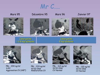Mr C….
    Mars 95            Décembre 95         Mars 96             Janvier 97




             Cabergoline
             Cabergoline                        Cabergoline
                                                Cabergoline
          1 à 8 mg/semaine
          1 à 8 mg/semaine                     8 mg/semaine
                                               8 mg/semaine




PRL : 204 ng/ml        PRL : 224 ng/ml   PRL : 164 ng/ml      PRL : 120 ng/ml
AV                    10/10 ODG         10/10 ODG            10/10 ODG
Aggravation CV (HBT)   Amélioration CV   CV Normal            CV Normal
 