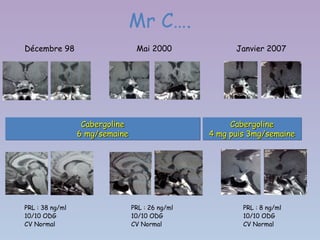 Mr C….
Décembre 98                      Mai 2000              Janvier 2007




                  Cabergoline
                  Cabergoline                         Cabergoline
                                                      Cabergoline
                 6 mg/semaine
                 6 mg/semaine                    4 mg puis 3mg/semaine
                                                 4 mg puis 3mg/semaine




PRL : 38 ng/ml                  PRL : 26 ng/ml           PRL : 8 ng/ml
10/10 ODG                       10/10 ODG                10/10 ODG
CV Normal                       CV Normal                CV Normal
 
