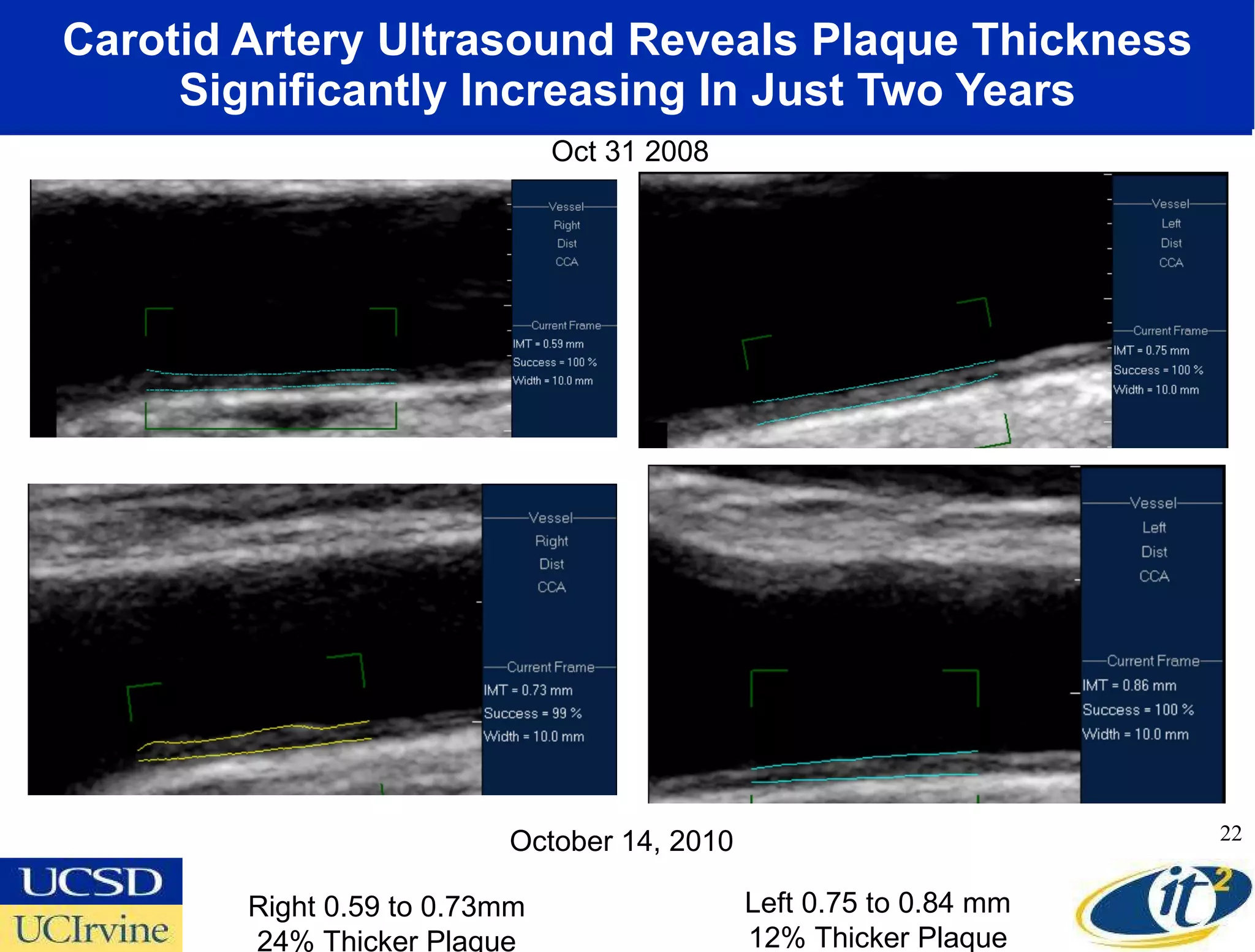Carotid Artery Ultrasound Reveals Plaque Thickness Significantly Increasing In Just Two Years October 14, 2010 Oct 31 2008 Right 0.59 to 0.73mm 24% Thicker Plaque Left 0.75 to 0.84 mm 12% Thicker Plaque 