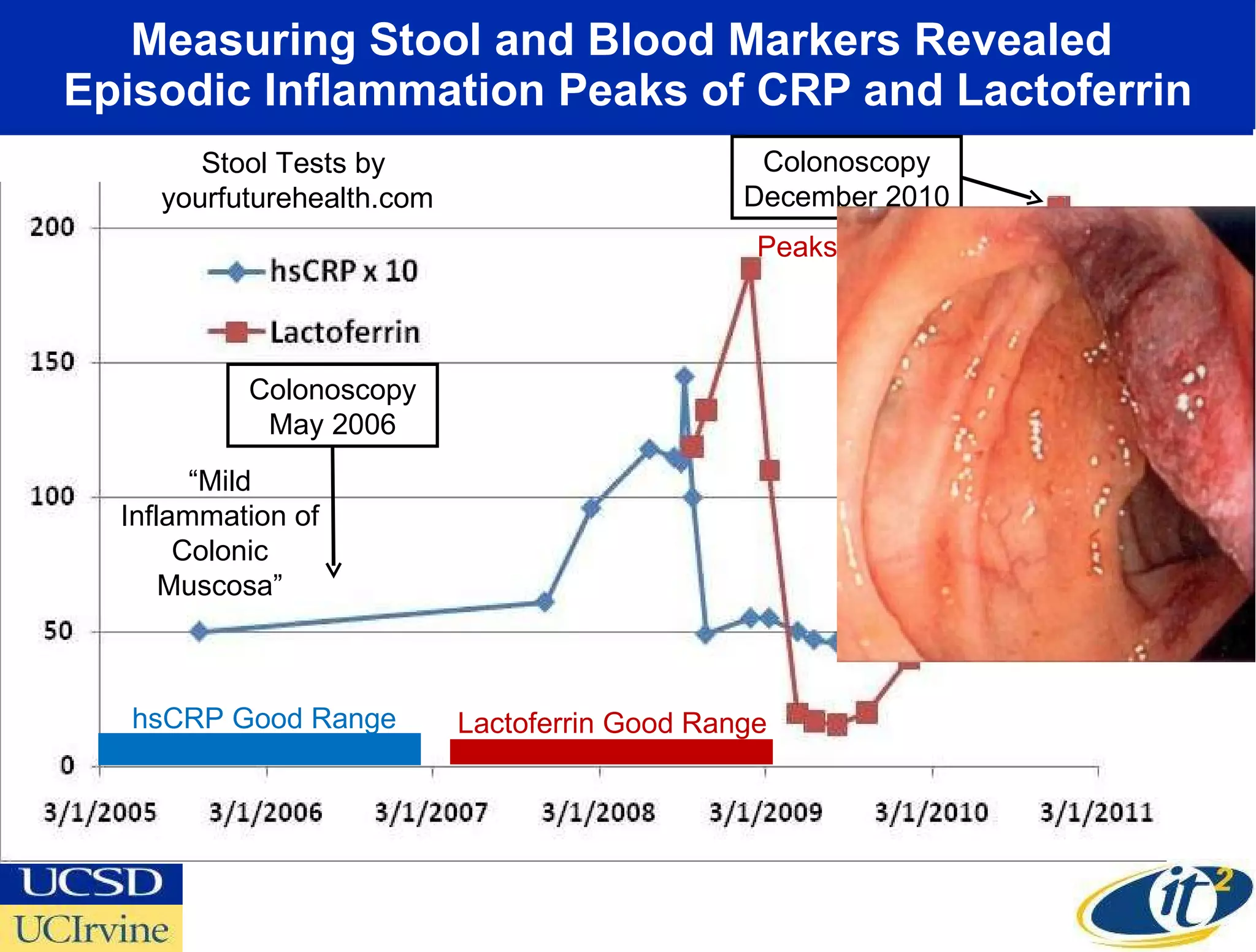 Measuring Stool and Blood Markers Revealed  Episodic Inflammation Peaks of CRP and Lactoferrin Stool Tests by  yourfuturehealth.com Peaks 25-30x Normal “ Significant Inflammation  of Sigmoid Colon”  Lactoferrin Good Range hsCRP Good Range Colonoscopy December 2010 Colonoscopy May 2006 “ Mild Inflammation of Colonic Muscosa” 