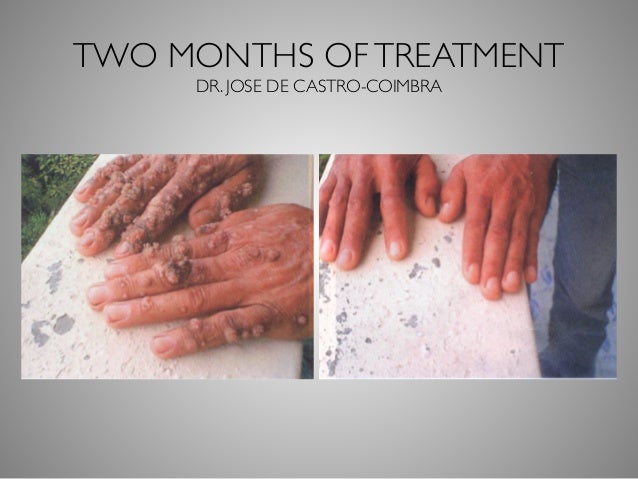 Dr Phil Mollica On Ozone In Dentistry