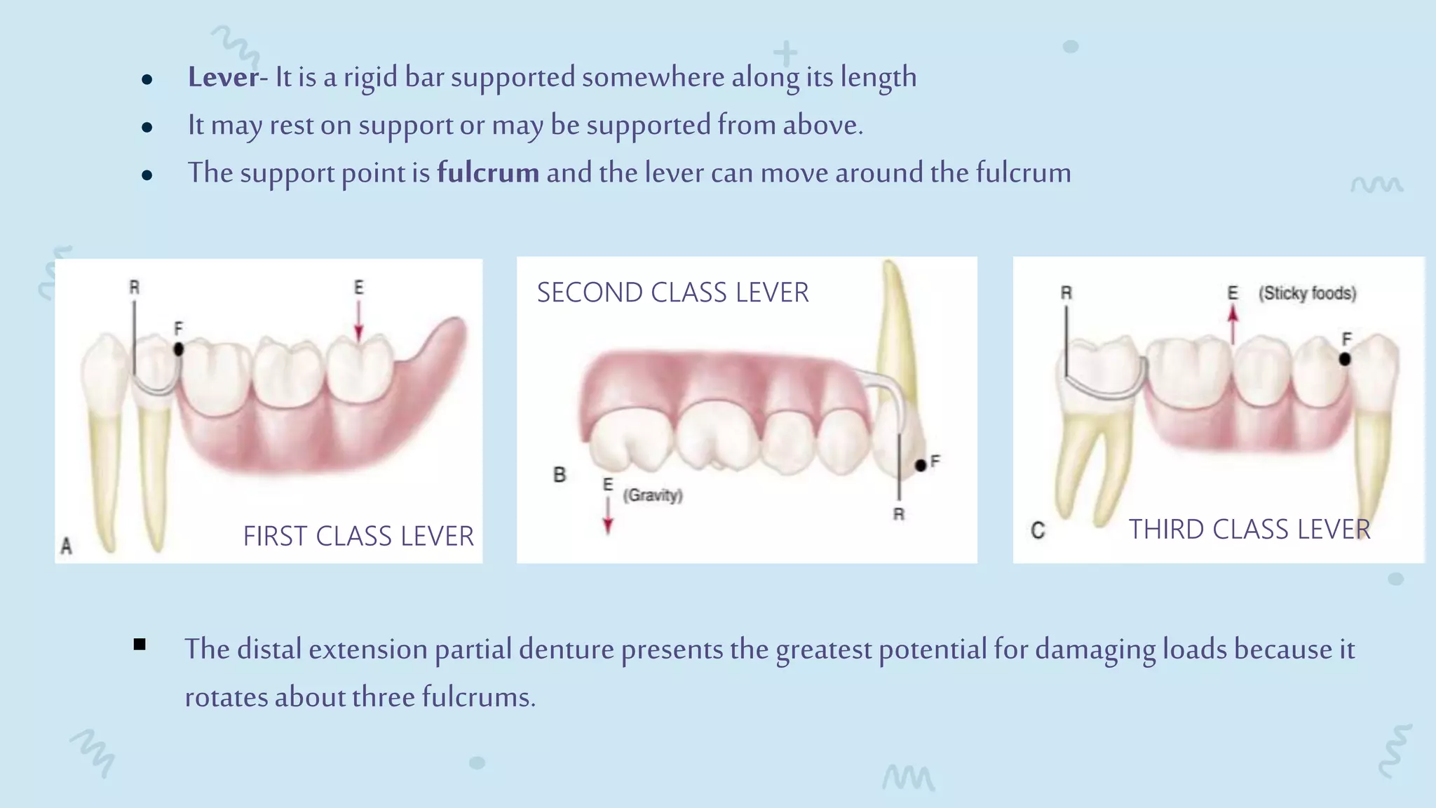 Lever Arm Rpd Philosophy of rpd | PPTX