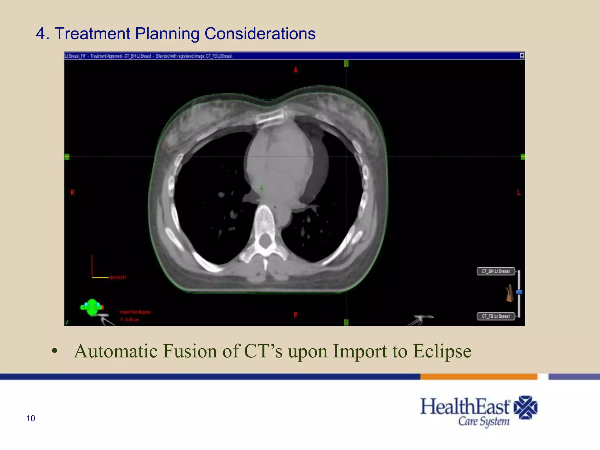 10
4. Treatment Planning Considerations
• Automatic Fusion of CT’s upon Import to Eclipse
 