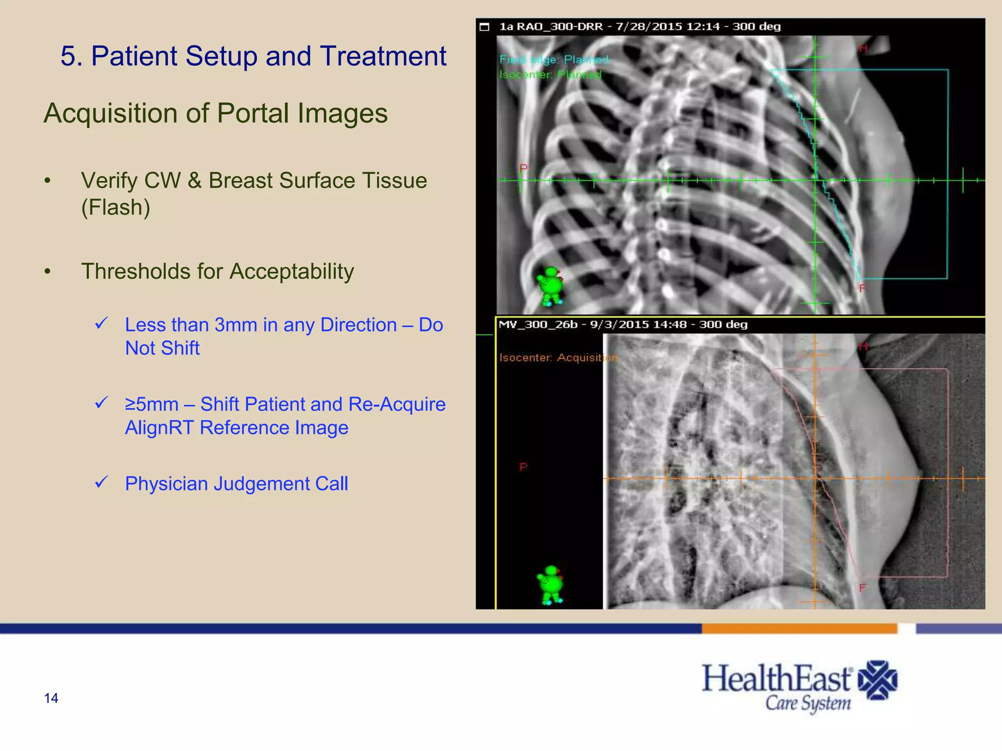 14
5. Patient Setup and Treatment
Acquisition of Portal Images
• Verify CW & Breast Surface Tissue
(Flash)
• Thresholds for Acceptability
 Less than 3mm in any Direction – Do
Not Shift
 ≥5mm – Shift Patient and Re-Acquire
AlignRT Reference Image
 Physician Judgement Call
 