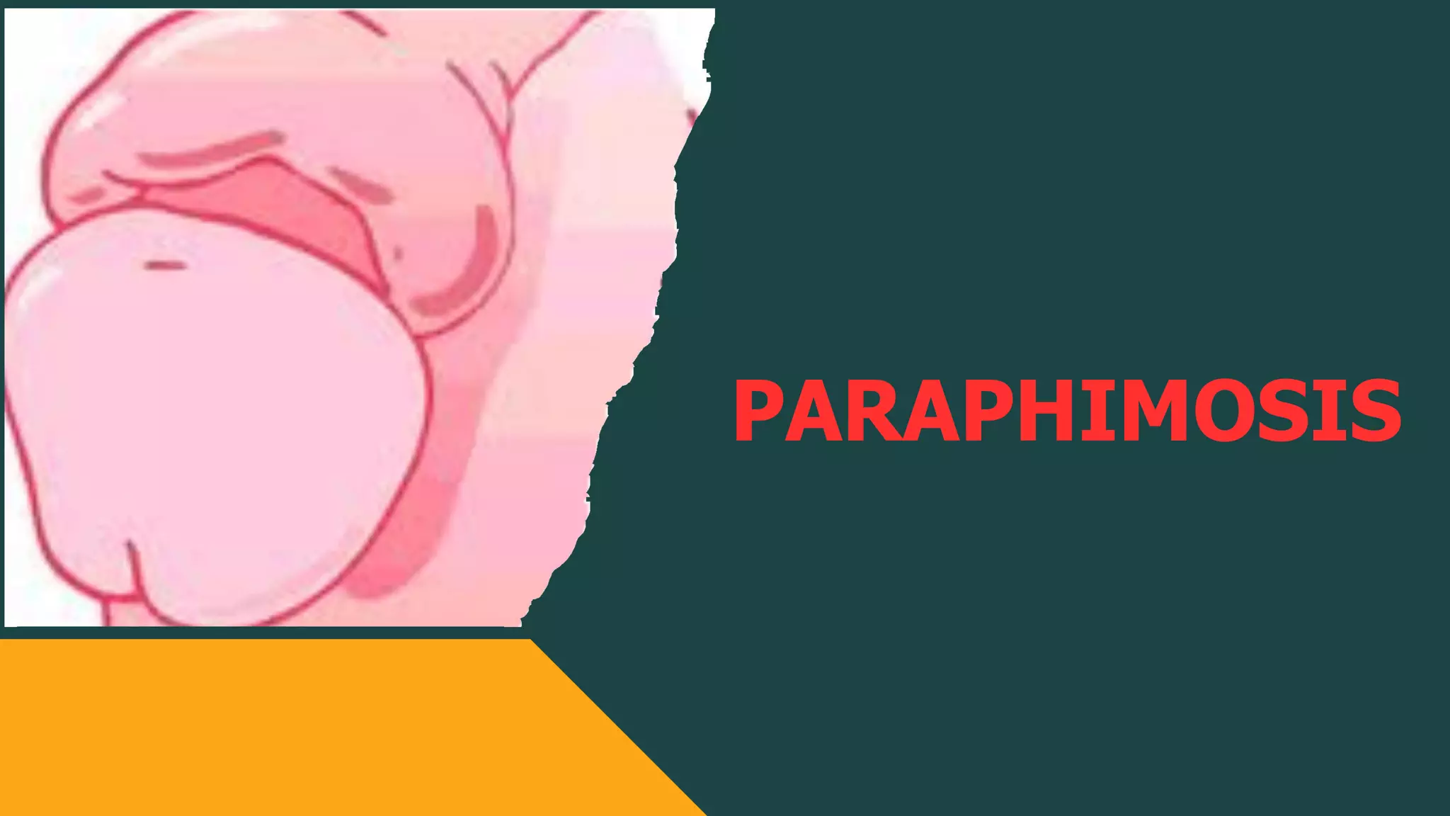 Paraphimosis And Priapism , Phimosis and Paraphimosis – TMBI