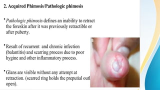 Phimo Problem Comprehensive Overview of Phimosis: Causes, Symptoms, and Treatments | PPTX