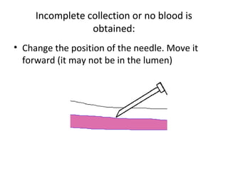 Incomplete collection or no blood is
obtained:
• Change the position of the needle. Move it
forward (it may not be in the lumen)
 