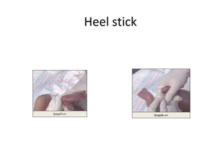 Heel stick
 
