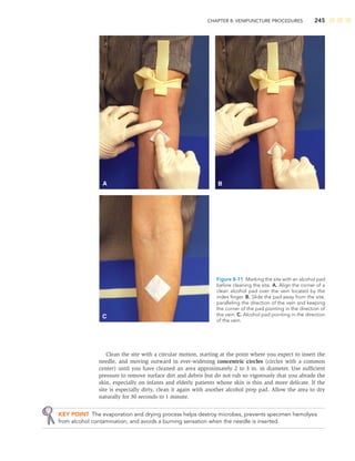 CHAPTER 8: VENIPUNCTURE PROCEDURES 245
Clean the site with a circular motion, starting at the point where you expect to insert the
needle, and moving outward in ever-widening concentric circles (circles with a common
center) until you have cleaned an area approximately 2 to 3 in. in diameter. Use sufﬁcient
pressure to remove surface dirt and debris but do not rub so vigorously that you abrade the
skin, especially on infants and elderly patients whose skin is thin and more delicate. If the
site is especially dirty, clean it again with another alcohol prep pad. Allow the area to dry
naturally for 30 seconds to 1 minute.
KEY POINT The evaporation and drying process helps destroy microbes, prevents specimen hemolysis
from alcohol contamination, and avoids a burning sensation when the needle is inserted.
A B
C
Figure 8-11 Marking the site with an alcohol pad
before cleaning the site. A. Align the corner of a
clean alcohol pad over the vein located by the
index ﬁnger. B. Slide the pad away from the site,
paralleling the direction of the vein and keeping
the corner of the pad pointing in the direction of
the vein. C. Alcohol pad pointing in the direction
of the vein.
 