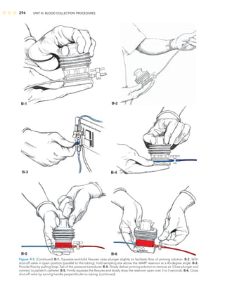 294 UNIT III: BLOOD COLLECTION PROCEDURES
B-1 B-2
B-3 B-4
B-5 B-6
Figure 9-5 (Continued) B-1. Squeeze-and-hold ﬂexures raise plunger slightly to facilitate ﬂow of priming solution. B-2. With
shut-off valve in open position (parallel to the tubing), hold sampling site above the VAMP reservoir at a 45-degree angle. B-3.
Provide ﬂow by pulling Snap-Tab of the pressure transducer. B-4. Slowly deliver priming solution to remove air. Close plunger and
connect to patient’s catheter. B-5. Firmly squeeze the ﬂexures and slowly draw the reservoir open over 3 to 5 seconds. B-6. Close
shut-off valve by turning handle perpendicular to tubing. (continued)
 