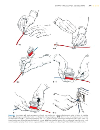 CHAPTER 9: PREANALYTICAL CONSIDERATIONS 295
B-7
B-8
B-9 B-10
B-11 B-12
Figure 9-5 (Continued) B-7. Swab sample port and push tube holder onto it. B-8. Collect required tubes of blood via the tube
holder. B-9. Gently remove the tube holder from the port by pulling straight out. B-10. Open the shut-off valve by turning the handle
parallel to the tubing. B-11. Smoothly and evenly, over 3 to 5 seconds, depress the plunger until ﬂexures lock in place in the fully
closed position and all ﬂuid has been reinfused into the line. B-12. Flush the VAMP system clear by pulling the Snap-Tab on the trans-
ducer. Swab the sampling site to remove any excess blood on the sampling port. (Courtesy of Edwards Lifesciences, Irvine, CA.)
 