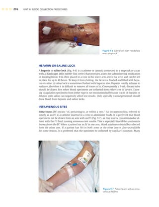 296 UNIT III: BLOOD COLLECTION PROCEDURES
HEPARIN OR SALINE LOCK
A heparin or saline lock (Fig. 9-6) is a catheter or cannula connected to a stopcock or a cap
with a diaphragm (thin rubber-like cover) that provides access for administering medication
or drawing blood. It is often placed in a vein in the lower arm above the wrist and can be left
in place for up to 48 hours. To keep it from clotting, the device is ﬂushed and ﬁlled with hepa-
rin or saline. A saline lock is sometimes ﬂushed with heparin also. Heparin readily adheres to
surfaces; therefore it is difﬁcult to remove all traces of it. Consequently a 5-mL discard tube
should be drawn ﬁrst when blood specimens are collected from either type of device. Draw-
ing coagulation specimens from either type is not recommended because traces of heparin or
dilution with saline can negatively affect test results. Only specially trained personnel should
draw blood from heparin and saline locks.
INTRAVENOUS SITES
Intravenous (IV) means “of, pertaining to, or within a vein.” An intravenous line, referred to
simply as an IV, is a catheter inserted in a vein to administer ﬂuids. It is preferred that blood
specimens not be drawn from an arm with an IV (Fig. 9-7), as they can be contaminated or di-
luted with the IV ﬂuid, causing erroneous test results. This is especially true if the specimen is
drawn above the IV. When a patient has an IV in one arm, blood specimens should be collected
from the other arm. If a patient has IVs in both arms or the other arm is also unavailable
for some reason, it is preferred that the specimen be collected by capillary puncture. Many
Figure 9-6 Saline lock with needleless
entry stopcock.
Figure 9-7 Patient’s arm with an intra-
venous (IV) line.
 