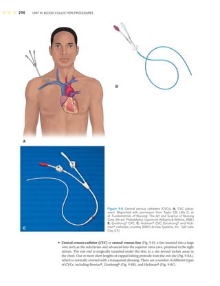 298 UNIT III: BLOOD COLLECTION PROCEDURES
• Central venous catheter (CVC) or central venous line (Fig. 9-8): a line inserted into a large
vein such as the subclavian and advanced into the superior vena cava, proximal to the right
atrium. The exit end is surgically tunneled under the skin to a site several inches away in
the chest. One or more short lengths of capped tubing protrude from the exit site (Fig. 9-8A),
which is normally covered with a transparent dressing. There are a number of different types
of CVCs, including Broviac®, Groshong® (Fig. 9-8B), and Hickman® (Fig. 9-8C).
A
C
B
Figure 9-8 Central venous catheters (CVCs). A. CVC place-
ment. (Reprinted with permission from Taylor CR, Lillis C, et
al. Fundamentals of Nursing: The Art and Science of Nursing
Care, 6th ed. Philadelphia: Lippincott Williams  Wilkins, 2008.)
B. Groshong®
CVC. C. Hickman®
CVC (Groshong®
and Hick-
man®
catheters courtesy BARD Access Systems, Inc., Salt Lake
City, UT.)
 