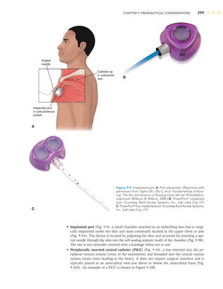 CHAPTER 9: PREANALYTICAL CONSIDERATIONS 299
• Implanted port (Fig. 9-9): a small chamber attached to an indwelling line that is surgi-
cally implanted under the skin and most commonly located in the upper chest or arm
(Fig. 9-9A). The device is located by palpating the skin and accessed by inserting a spe-
cial needle through the skin into the self-sealing septum (wall) of the chamber (Fig. 9-9B).
The site is not normally covered with a bandage when not in use.
• Peripherally inserted central catheter (PICC) (Fig. 9-10): a line inserted into the pe-
ripheral venous system (veins of the extremities) and threaded into the central venous
system (main veins leading to the heart). It does not require surgical insertion and is
typically placed in an antecubital vein just above or below the antecubital fossa (Fig.
9-10A). An example of a PICC is shown in Figure 9-10B.
Angled
needle
Implanted port
in subcutaneous
pocket
A
C
B
Catheter tip
in sublcavian
vein
Figure 9-9 Implanted port. A. Port placement. (Reprinted with
permission from Taylor CR, Lillis C, et al. Fundamentals of Nurs-
ing: The Art and Science of Nursing Care, 6th ed. Philadelphia:
Lippincott Williams  Wilkins, 2008.) B. PowerPort®
implanted
port. (Courtesy Bard Access Systems, Inc., Salt Lake City, UT.)
C.PowerPort®
Duoimplantedport.(CourtesyBardAccess Systems,
Inc., Salt Lake City, UT.)
 