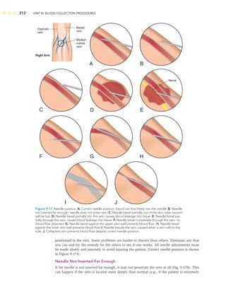 312 UNIT III: BLOOD COLLECTION PROCEDURES
positioned in the vein. Some problems are harder to discern than others. Eliminate any that
you can and try the remedy for the others to see if one works. All needle adjustments must
be made slowly and precisely to avoid injuring the patient. Correct needle position is shown
in Figure 9-17A.
Needle Not Inserted Far Enough
If the needle is not inserted far enough, it may not penetrate the vein at all (Fig. 9-17B). This
can happen if the vein is located more deeply than normal (e.g., if the patient is extremely
Median
cubital
vein
Basilic
vein
Cephalic
vein
Right Arm
I J
H
G
F
E
Nerve
D
C
B
A
Figure 9-17 Needle position. A. Correct needle position; blood can ﬂow freely into the needle. B. Needle
not inserted far enough; needle does not enter vein. C. Needle bevel partially out of the skin; tube vacuum
will be lost. D. Needle bevel partially into the vein; causes blood leakage into tissue. E. Needle bevel par-
tially through the vein; causes blood leakage into tissue. F. Needle bevel completely through the vein; no
blood ﬂow obtained. G. Needle bevel against the upper vein wall prevents blood ﬂow. H. Needle bevel
against the lower vein wall prevents blood ﬂow. I. Needle beside the vein; caused when a vein rolls to the
side. J. Collapsed vein prevents blood ﬂow despite correct needle position.
 