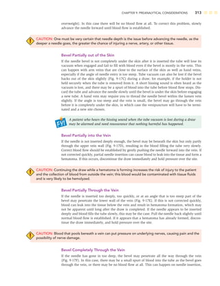 CHAPTER 9: PREANALYTICAL CONSIDERATIONS 313
overweight). In this case there will be no blood ﬂow at all. To correct this problem, slowly
advance the needle forward until blood ﬂow is established.
CAUTION: One must be very certain that needle depth is the issue before advancing the needle, as the
deeper a needle goes, the greater the chance of injuring a nerve, artery, or other tissue.
Bevel Partially out of the Skin
If the needle bevel is not completely under the skin after it is inserted the tube will lose its
vacuum when engaged and fail to ﬁll with blood even if the bevel is mostly in the vein. This
can happen with arm veins that are close to the surface of the skin as well as hand veins,
especially if the angle of needle entry is too steep. Tube vacuum can also be lost if the bevel
backs out of the skin slightly (Fig. 9-17C) during a draw; for example, if the holder is not
held securely when the tube is removed from it. A short hissing sound is often heard as the
vacuum is lost, and there may be a spurt of blood into the tube before blood ﬂow stops. Dis-
card the tube and advance the needle slowly until the bevel is under the skin before engaging
a new tube. A hand vein may require you to thread the needle bevel within the lumen vein
slightly. If the angle is too steep and the vein is small, the bevel may go through the vein
before it is completely under the skin, in which case the venipuncture will have to be termi-
nated and a new site chosen.
A patient who hears the hissing sound when the tube vacuum is lost during a draw
may be alarmed and need reassurance that nothing harmful has happened.
Bevel Partially into the Vein
If the needle is not inserted deeply enough, the bevel may be beneath the skin but only partly
through the upper vein wall (Fig. 9-17D), resulting in the blood ﬁlling the tube very slowly.
Correct blood ﬂow should be established by gently pushing the needle forward into the vein. If
not corrected quickly, partial needle insertion can cause blood to leak into the tissue and form a
hematoma. If this occurs, discontinue the draw immediately and hold pressure over the site.
CAUTION: Continuing the draw while a hematoma is forming increases the risk of injury to the patient
and the collection of blood from outside the vein; this blood would be contaminated with tissue ﬂuids
and is very likely to be hemolyzed.
Bevel Partially Through the Vein
If the needle is inserted too deeply, too quickly, or at an angle that is too steep part of the
bevel may penetrate the lower wall of the vein (Fig. 9-17E). If this is not corrected quickly,
blood can leak into the tissue below the vein and result in hematoma formation, which may
not be apparent until long after the draw is completed. If the needle appears to be inserted
deeply and blood ﬁlls the tube slowly, this may be the case. Pull the needle back slightly until
normal blood ﬂow is established. If it appears that a hematoma has already formed, discon-
tinue the draw immediately, and hold pressure over the site.
CAUTION: Blood that pools beneath a vein can put pressure on underlying nerves, causing pain and the
possibility of nerve damage.
Bevel Completely Through the Vein
If the needle has gone in too deep, the bevel may penetrate all the way through the vein
(Fig. 9-17F). In this case, there may be a small spurt of blood into the tube as the bevel goes
through the vein, or there may be no blood ﬂow at all. This can happen on needle insertion,
 