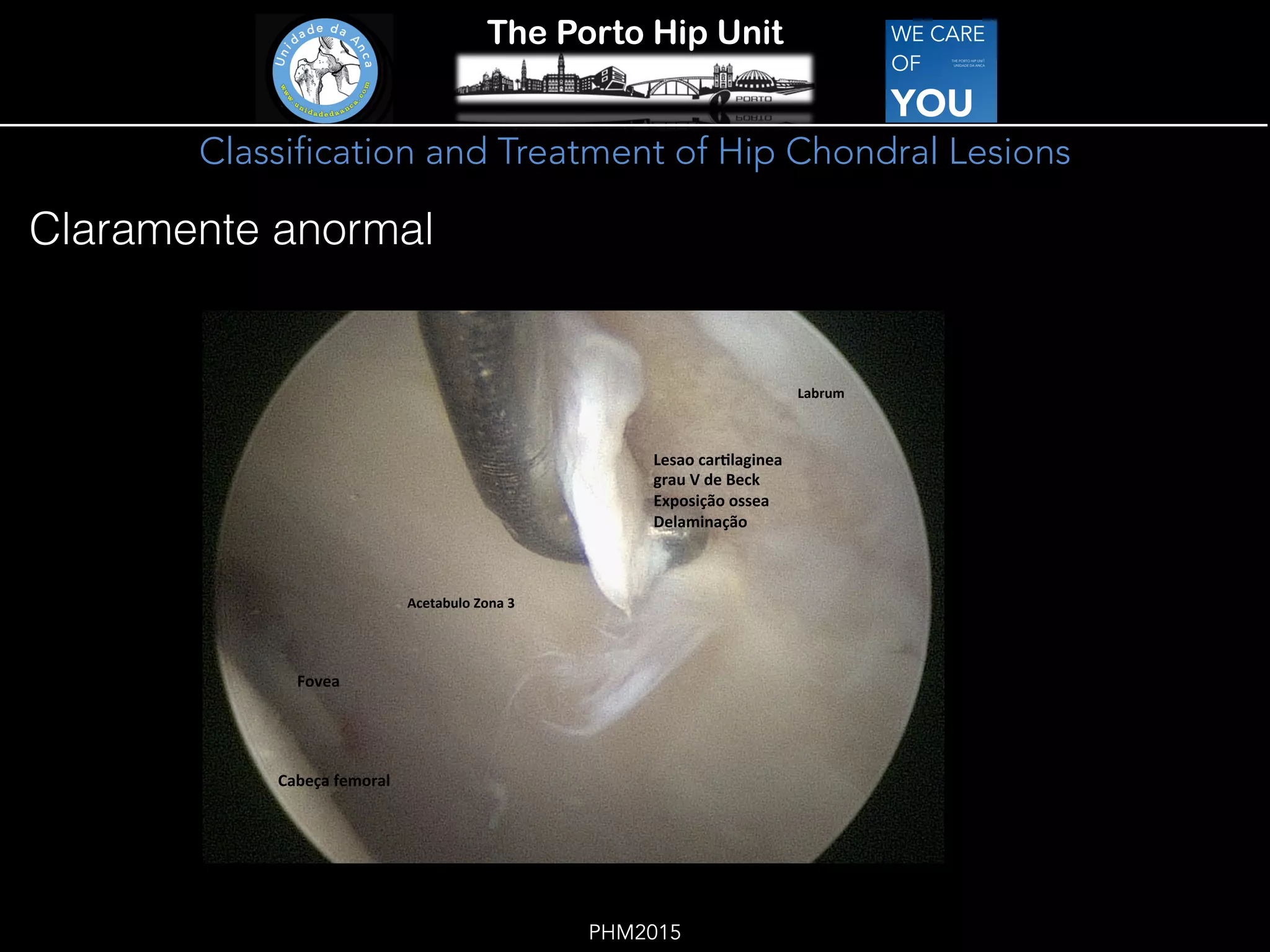 Classification and Treatment of Hip Chondral Lesions | PDF