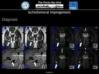 The Porto Hip Unit
PHM2015
Ischiofemoral Impingement
Diagnosis
 
