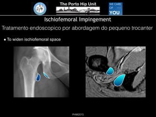 The Porto Hip Unit
PHM2015
Ischiofemoral Impingement
! To widen ischiofemoral space
Tratamento endoscopico por abordagem do pequeno trocanter
 