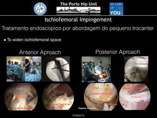 The Porto Hip Unit
PHM2015
Ischiofemoral Impingement
! To widen ischiofemoral space
Tratamento endoscopico por abordagem do pequeno trocanter
Lesser Trochanter
Lesser Trochanter
Iliopsoas
Iliopsoas
Posterior Aproach
Iliopsoas
Lesser Trochanter
Lesser Trochanter
Anterior Aproach
 