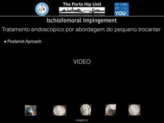 The Porto Hip Unit
PHM2015
Ischiofemoral Impingement
! Posteriot Aproach
Tratamento endoscopico por abordagem do pequeno trocanter
VIDEO
 