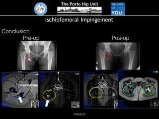 The Porto Hip Unit
PHM2015
Ischiofemoral Impingement
Conclusion
Pre-op Pos-op
 