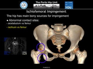 The Porto Hip Unit
PHM2015
Ischiofemoral Impingement
The hip has main bony sources for impingement
! Abnormal contact sites: 
- acetabulum vs femur
- ischium vs femur
!
 