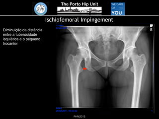 The Porto Hip Unit
PHM2015
Ischiofemoral Impingement
Diminuição da distância
entre a tuberosidade
isquiática e o pequeno
trocanter
!
 