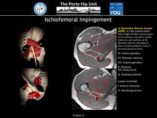 The Porto Hip Unit
PHM2015
Ischiofemoral Impingement
Q: Quadratus femoris muscle
(QFM) is a flat muscle which
has a orgin on the Lateral margin
of the obturator ring above ischial
tuberosity and insertion on the
Quadrate tubercle and adjacent
bone of intertrochanteric crest of
proximal posterior femur.
IG: Inferior gemellus
OI: Obturator internius
SG: Superiorgemellus
P: Piriformis 
SN: Sciaticnerve.
Q: Quadratus femoris
Lesser trochanter
I: Ischium tuberosity
H: Hamstrings tendon
 
