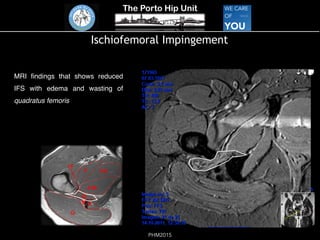 The Porto Hip Unit
PHM2015
Ischiofemoral Impingement
MRI ﬁndings that shows reduced
IFS with edema and wasting of
quadratus femoris
 