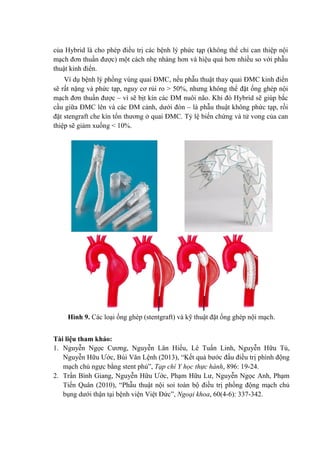 của Hybrid là cho phép điều trị các bệnh lý phức tạp (không thể chỉ can thiệp nội
mạch đơn thuần được) một cách nhẹ nhàng hơn và hiệu quả hơn nhiều so với phẫu
thuật kinh điển.
Ví dụ bệnh lý phồng vùng quai ĐMC, nếu phẫu thuật thay quai ĐMC kinh điển
sẽ rất nặng và phức tạp, nguy cơ rủi ro > 50%, nhưng không thể đặt ống ghép nội
mạch đơn thuần được – vì sẽ bịt kín các ĐM nuôi não. Khi đó Hybrid sẽ giúp bắc
cầu giữa ĐMC lên và các ĐM cảnh, dưới đòn – là phẫu thuật không phức tạp, rồi
đặt stengraft che kín tổn thương ở quai ĐMC. Tỷ lệ biến chứng và tử vong của can
thiệp sẽ giảm xuống < 10%.
Hình 9. Các loại ống ghép (stentgraft) và kỹ thuật đặt ống ghép nội mạch.
Tài liệu tham khảo:
1. Nguyễn Ngọc Cương, Nguyễn Lân Hiếu, Lê Tuấn Linh, Nguyễn Hữu Tú,
Nguyễn Hữu Ước, Bùi Văn Lệnh (2013), “Kết quả bước đầu điều trị phình động
mạch chủ ngực bằng stent phủ”, Tạp chí Y học thực hành, 896: 19-24.
2. Trần Bình Giang, Nguyễn Hữu Ước, Phạm Hữu Lư, Nguyễn Ngọc Anh, Phạm
Tiến Quân (2010), “Phẫu thuật nội soi toàn bộ điều trị phồng động mạch chủ
bụng dưới thận tại bệnh viện Việt Đức”, Ngoại khoa, 60(4-6): 337-342.
 