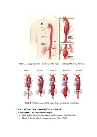 Hình 1. A: Động mạch chủ – B: Phồng ĐMC ngực – C: Phồng ĐMC bụng dưới thận
Hình 2. Phân loại phồng ĐMC ngực - bụng của Crawford (cải biên).
3. DỊCH TỄ HỌC CỦA PHỒNG ĐỘNG MẠCH CHỦ
3.1. Phồng ĐMC do xơ vữa thành mạch
- Tuổi: phồng ĐMC thường xảy ra ở những người 60 tuổi trở lên.
- Thuốc lá là một yếu tố nguy cơ cao của phồng ĐMC.
Nhóm I Nhóm II Nhóm III Nhóm IV Nhóm V
 